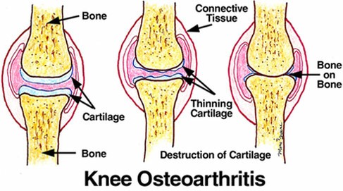 Arthritic joints