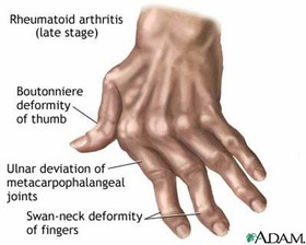 Athritic hands